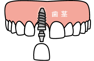 インプラント