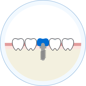 インプラント